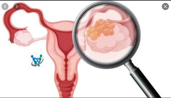 هل استئصال الرحم يؤثر على العلاقه الزوجيه 2 هل استئصال الرحم يؤثر على العلاقه الزوجيه